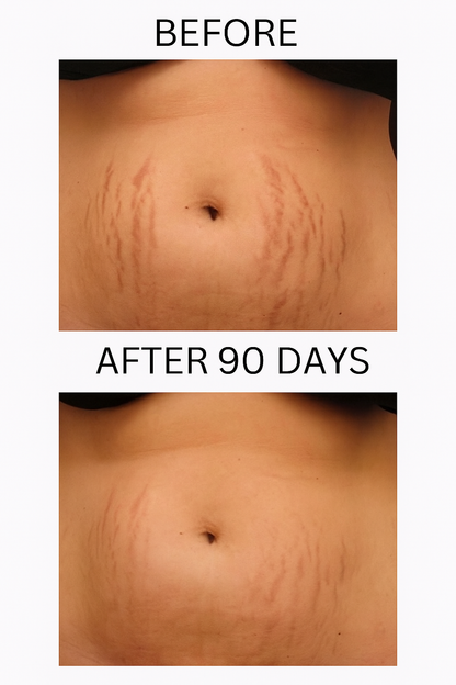 FADEE™ Stretch Marks & Loose Skin Patch ( 2 )