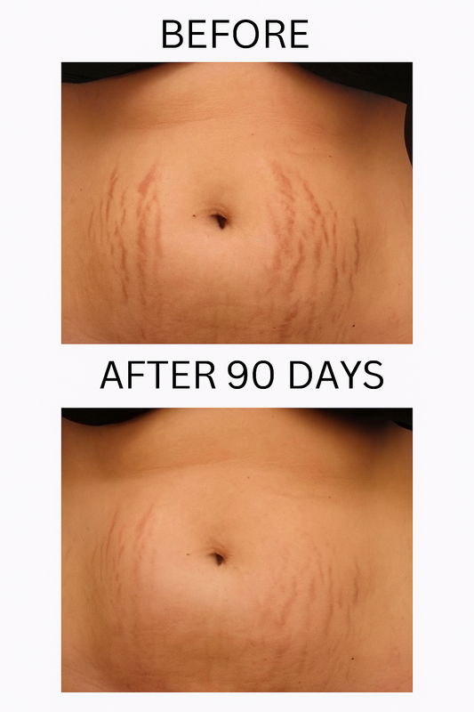 FADEE™ Stretch Marks & Loose Skin Patch ( 2 )