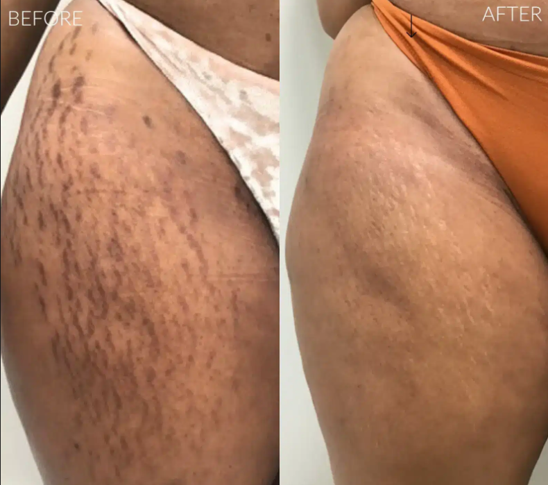 FADEE™ Stretch Marks & Loose Skin Patch ( 2 )