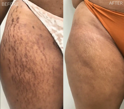 FADEE™ Stretch Marks & Loose Skin Patch ( 2 )